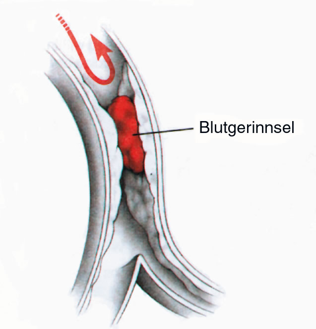 Verschluß