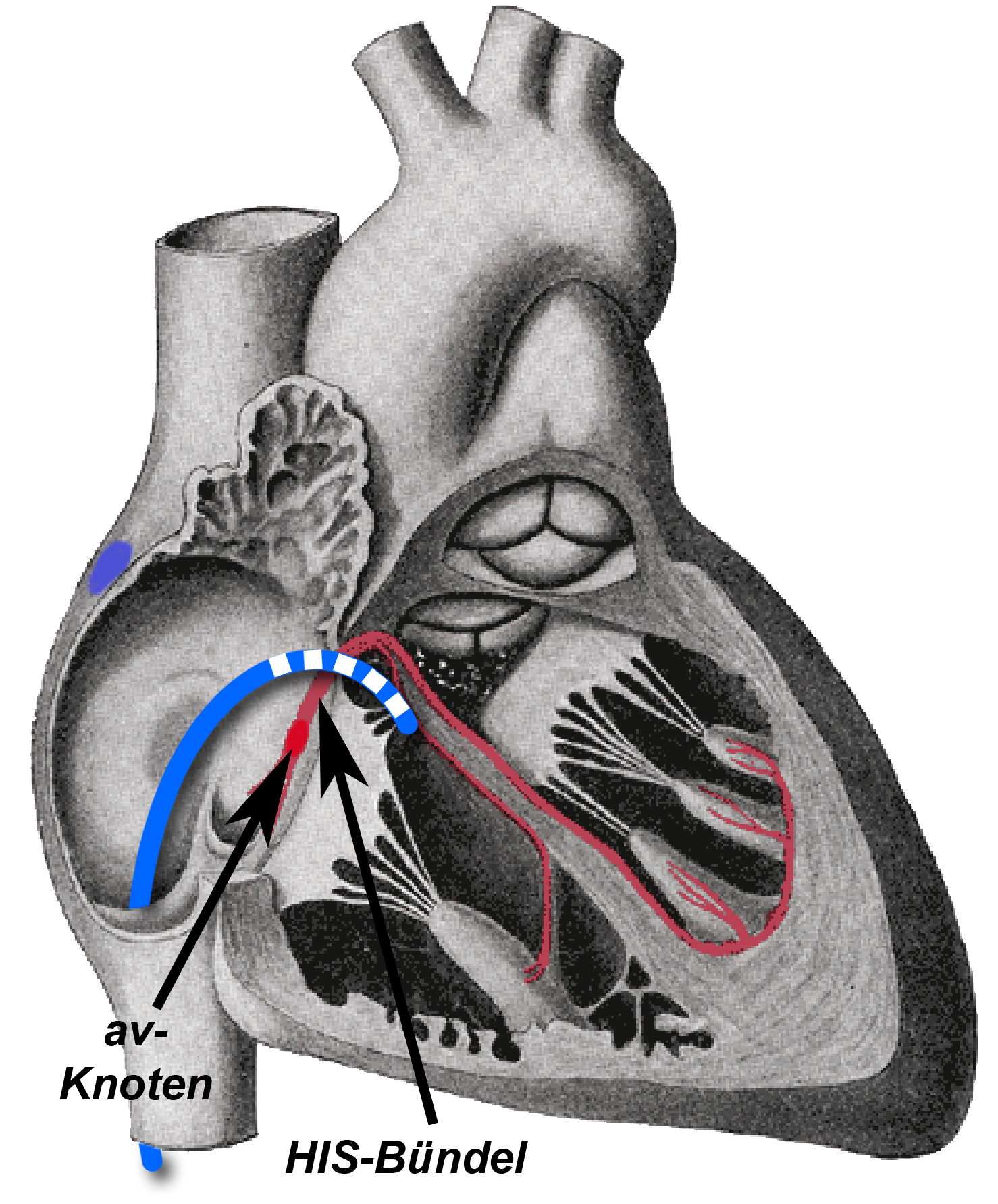 His-Bündel-Katheter