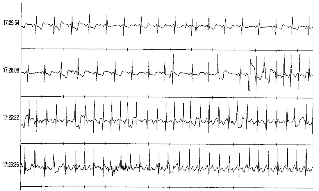 Elektrik des Herzens
